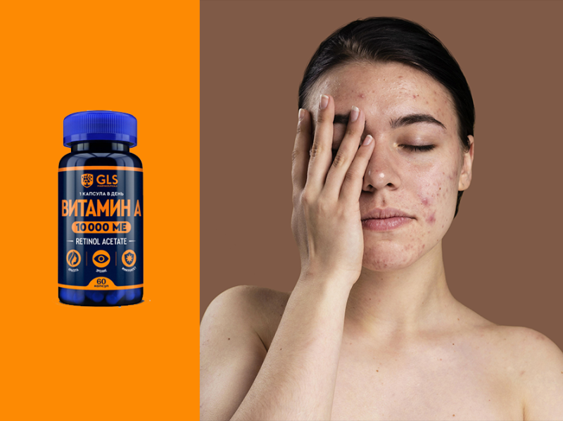 3 правила для чистой кожи. Избавься от прыщей навсегда