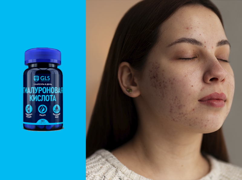 Морщины, акне и пигментация: как с этим бороться Морщины, акне и пигментация: как с этим бороться